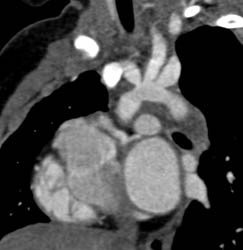 Stenosis of Origin of All Branch Vessels Off the Arch in Patient With Complex Cardiac Disorder. Note Use of Vessel Tracking - CTisus CT Scan