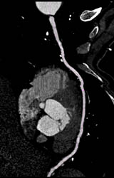 Patent Bypass Graft in Multiple Views With Multiple Renderings - CTisus CT Scan