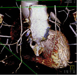 RCA Arises Off Left Cusp and Passes Between Ascending Aorta and Pulmonary Artery- Malignant Configuration - CTisus CT Scan