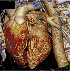 LAD With Plaque in Multiple Perspectives - CTisus CT Scan