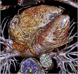 Normal RCA in Multiple Perspectives - CTisus CT Scan