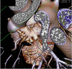 Normal LAD in Multiple Perspectives - CTisus CT Scan