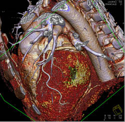 Normal LAD and Circumflex in 3D - CTisus CT Scan