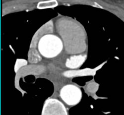 Normal Atrial Appendage in 3D Perspective - CTisus CT Scan