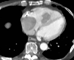 Metastatic Thyroid Cancer to Right Atrium and Right Ventricle - CTisus CT Scan