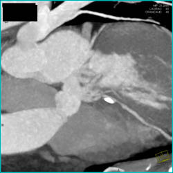 Calcified and Noncalcified Plaque in LAD - CTisus CT Scan