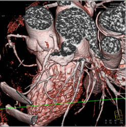 RCA With Multiple Calcified Plaques - CTisus CT Scan