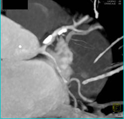 LAD Plaques With Stenosis Less Than 50% - CTisus CT Scan