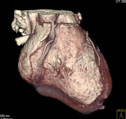 Editing of Data Needed to Fix Step-off. See Full Sequence - CTisus CT Scan