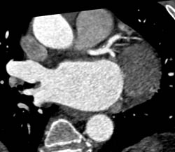 Non-calcified and Calcified Plaque in LAD - CTisus CT Scan