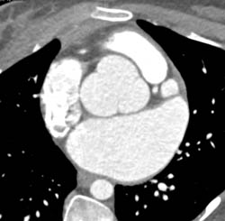 Dilated Sinus of Valsalva in Marfan Syndrome - CTisus CT Scan