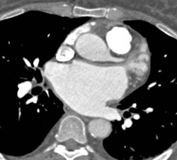 Aberrant RCA Off the Left Cusp - CTisus CT Scan