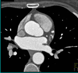 Av Nodal Branch Off the RCA - CTisus CT Scan