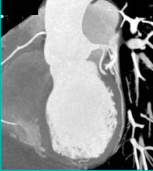 LAD Plaque Without Stenosis of Note - CTisus CT Scan