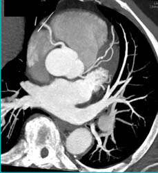 Stenosis in Proximal LAD - CTisus CT Scan