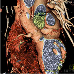 Re-implanted RCA Into Aortic Root - CTisus CT Scan