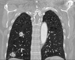 Atrial Myxomas With Lung Nodules - CTisus CT Scan