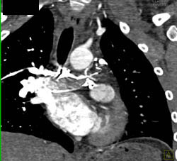 Fontan Shunt Not Opacified on Early Images in Patient With Single Ventricle - CTisus CT Scan