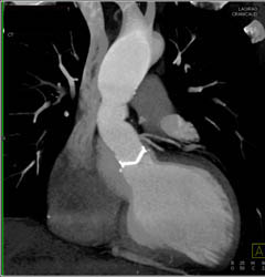 Aortic Valve Replacement With Aortic Root Repair - CTisus CT Scan