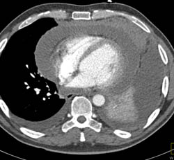 Huge Pericardial Effusion in Lymphoma Patient - CTisus CT Scan