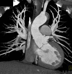 Reimplanted Coronary Arteries - CTisus CT Scan