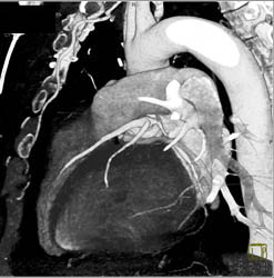 Repaired Aortic Root With Implanted Coronary Arteries - CTisus CT Scan