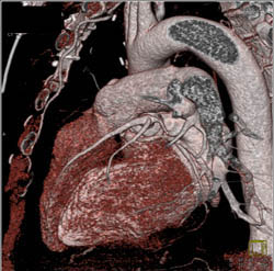 Repaired Aortic Root With Implanted Coronary Arteries - CTisus CT Scan