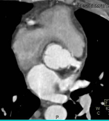 Repaired Aortic Root With Implanted Coronary Arteries - CTisus CT Scan