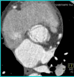 Repaired Aortic Root With Implanted Coronary Arteries - CTisus CT Scan