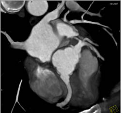 Repaired Aortic Root With Implanted Coronary Arteries - CTisus CT Scan