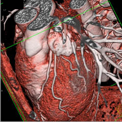 3D and MPR Sequence of Right Coronary Artery (RCA) - CTisus CT Scan