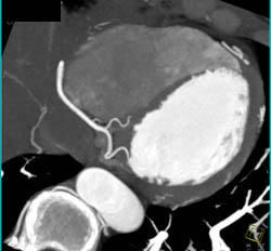 3D and MPR Sequence of Right Coronary Artery (RCA) - CTisus CT Scan