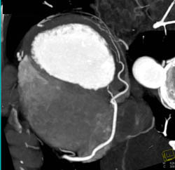 3D and MPR Sequence of Right Coronary Artery (RCA) - CTisus CT Scan