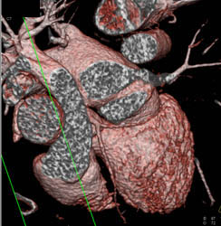 3D and MPR Sequence of Right Coronary Artery (RCA) - CTisus CT Scan