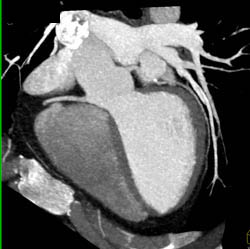 3D and MPR Sequence of Right Coronary Artery (RCA) - CTisus CT Scan