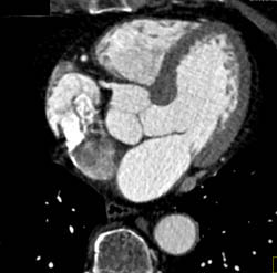 Normal Aortic Valve - CTisus CT Scan