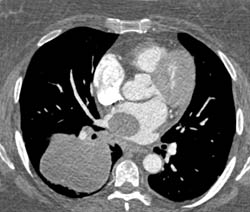 Metastatic Melanoma Invades the Left Atrium Via the Right Pulmonary Vein - CTisus CT Scan