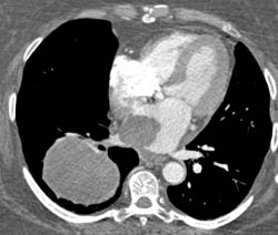 Metastatic Melanoma Invades the Left Atrium Via the Right Pulmonary Vein - CTisus CT Scan