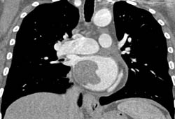 Metastatic Melanoma Invades the Left Atrium Via the Right Pulmonary Vein - CTisus CT Scan