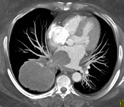 Metastatic Melanoma Invades the Left Atrium Via the Right Pulmonary Vein - CTisus CT Scan