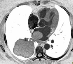 Metastatic Melanoma Invades the Left Atrium Via the Right Pulmonary Vein - CTisus CT Scan