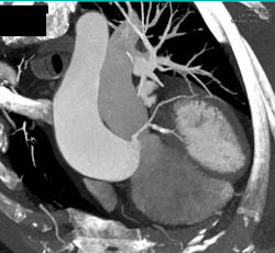 Dilated Aortic Root With Cad - CTisus CT Scan