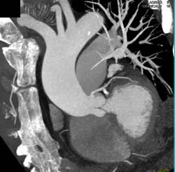 Dilated Aortic Root With Cad - CTisus CT Scan