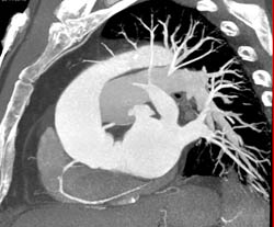 Dilated Aortic Root With Cad - CTisus CT Scan