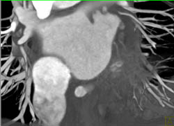 Right Side of Heart Optimal Visualization - CTisus CT Scan