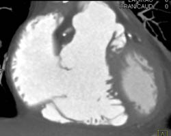 Right Side of Heart Optimal Visualization - CTisus CT Scan