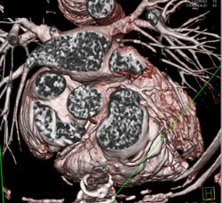 Left Anterior Descending Coronary Artery (LAD) Disease - CTisus CT Scan