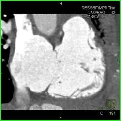 Normal Right Atrium and Ventricle - CTisus CT Scan