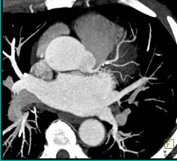 Left Anterior Descending Coronary Artery (LAD) Plaque - CTisus CT Scan