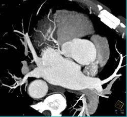 Left Anterior Descending Coronary Artery (LAD) Plaque - CTisus CT Scan